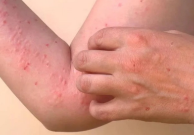 Nicaragua supera los 3,300 casos de chikungunya y autoridades reportan nuevo aumento semanal