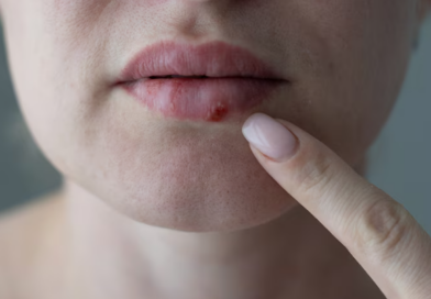 FDA aprueba nuevo antiviral oral contra el herpes resistente después de casi 30 años
